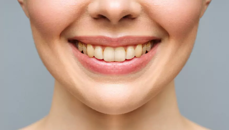 Before teeth whitening treatment
